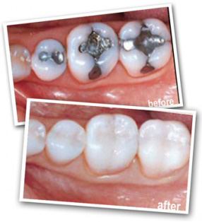 Dental White Fillings